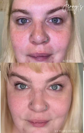 _ Healed- Semi-permanent concealer-webp